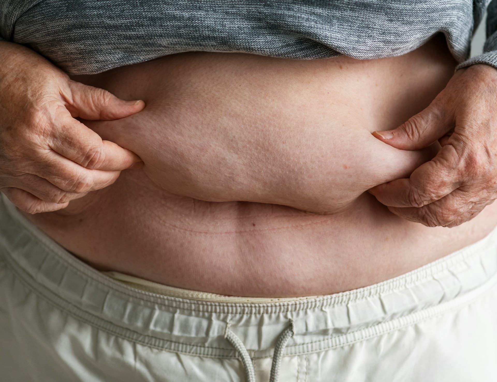 Why Does Stress Cause Belly Fat? Understanding Cortisol and Metaflammation