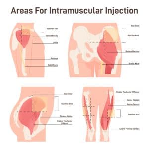 where to do semaglutide injections Where To Inject Semaglutide where to do semaglutide injections Where To Inject Semaglutide