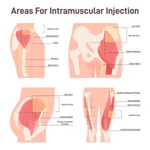 Where To Inject Semaglutide | Ivologist